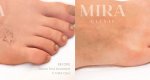 Mira-ba-tattooremoval-1