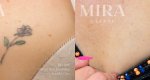 Mira-ba-tattooremoval-2