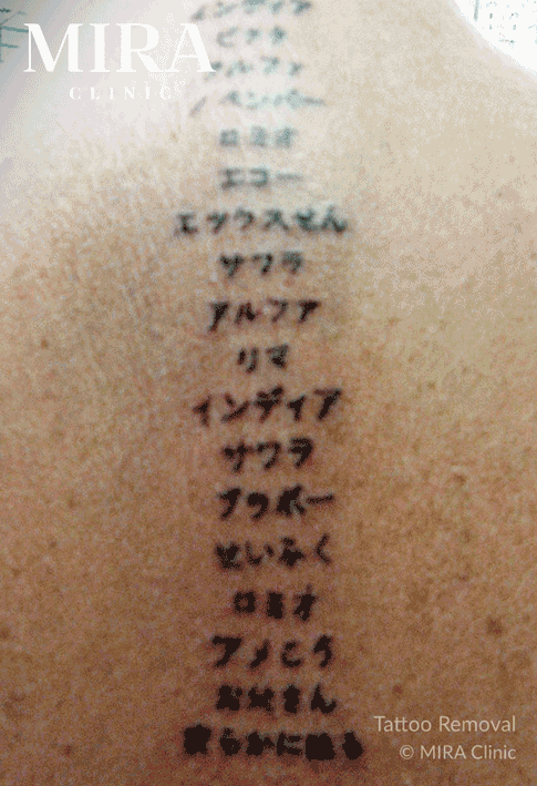 Mira tattoo gif - mira clinic - 5