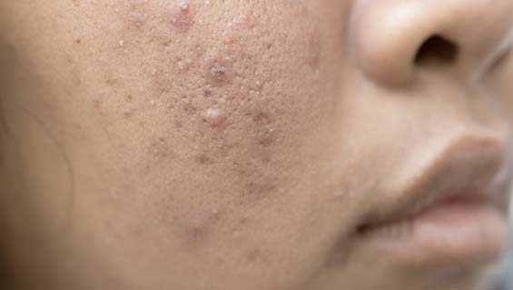 Acne - mira clinic - 1