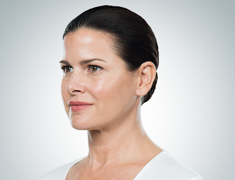 Double Chin Before And After Photos - 4 - Mira Clinic Fat dissolving injections - double chin - before and after - image 002b - after