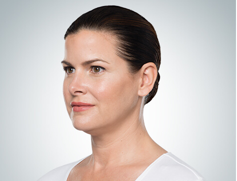 Double Chin Before And After Photos - 3 - Mira Clinic Double chin injections - before and after - image 002a - before