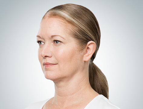 Double Chin Before And After Photos - 8 - Mira Clinic Fat dissolving injections before and after - image 005b - after