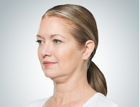 Double Chin Before And After Photos - 7 - Mira Clinic Fat dissolving injections - before and after - image 005a - before