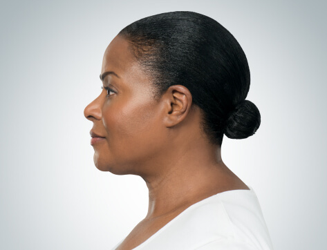Double Chin Before And After Photos - 12 - Mira Clinic Double chin fat removal - before and after - image 003b - after