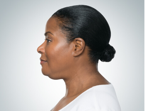 Double Chin Before And After Photos - 11 - Mira Clinic Double chin injections - before & afters - image 003a - before