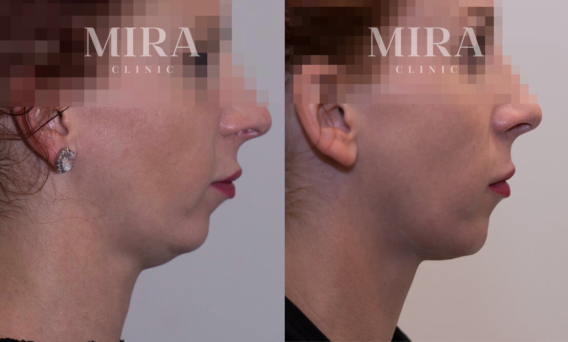 Double chin - fat dissolving injections