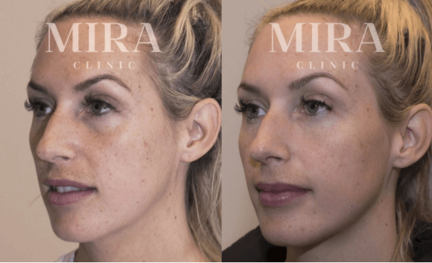 When to start with cosmetic procedures - prevention reasons