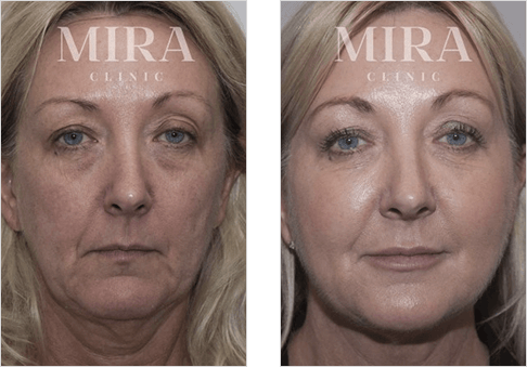 Carole bramston non-surgical makeover - mira clinic