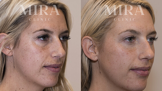 Prevention 1 - mira clinic - 4