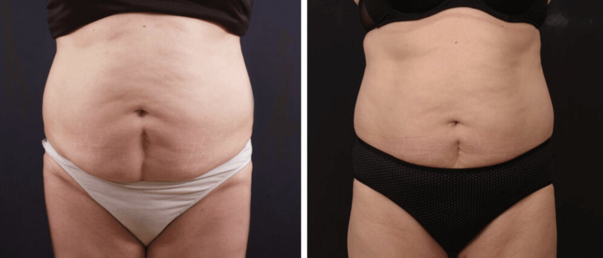 Vanquish fat reduction before and after - mira clinic perth