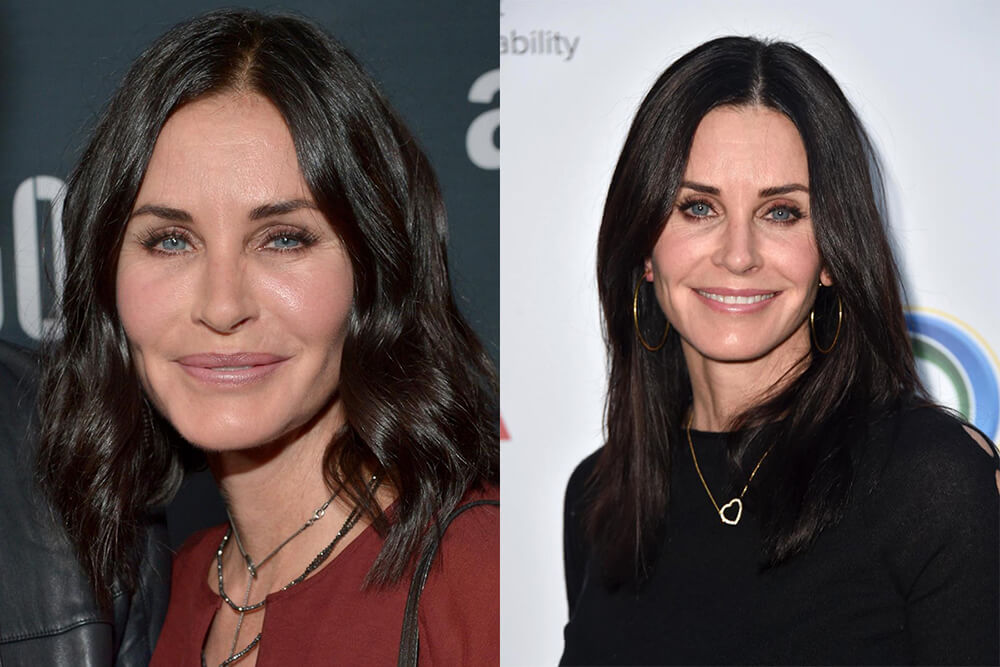 Dissolving dermal filler before and after - courtney fox