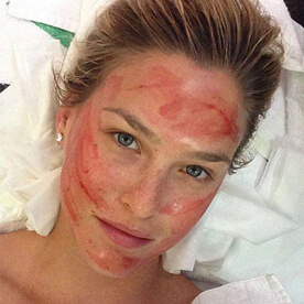 Platelet Rich Plasma Treatment - The ‘Vampire Facial’ Taking Hollywood By Storm - 7 - Mira Clinic Bar prp - mira clinic - 6