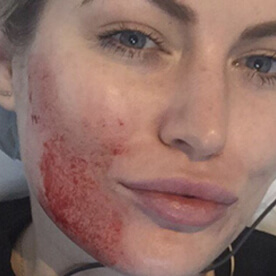 Platelet Rich Plasma Treatment - The ‘Vampire Facial’ Taking Hollywood By Storm - 5 - Mira Clinic Keira prp - mira clinic - 4