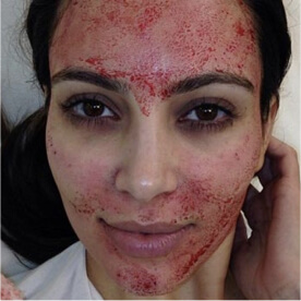 Platelet Rich Plasma Treatment - The ‘Vampire Facial’ Taking Hollywood By Storm - 3 - Mira Clinic Kim prp - mira clinic - 2