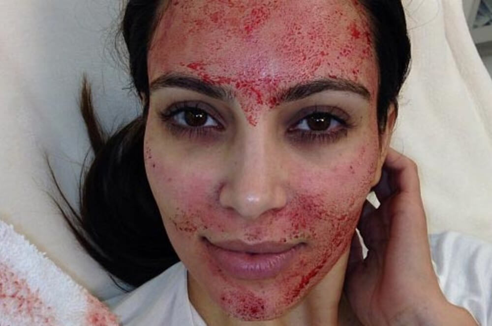 Vampire facial - prp treatment