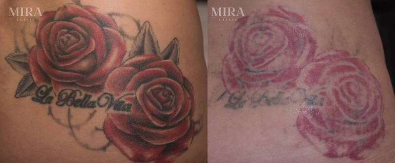 Laser tattoo removal before and after - blog post image - mira clinic perth