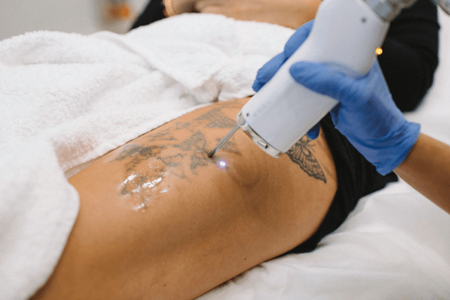 Laser tattoo removal - mira clinic perth