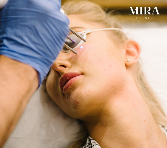 Ipl rejuvenation - mira clinic - 1