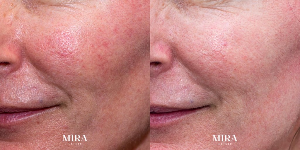 Laser genesis before and after image - mira clinic blog