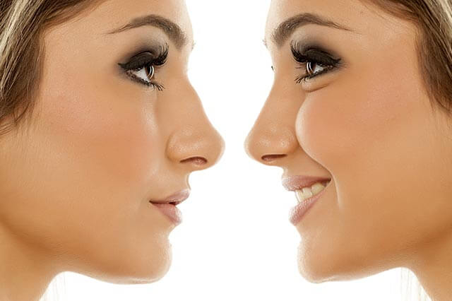 Liquid nose job - non-surgical rhinoplasty