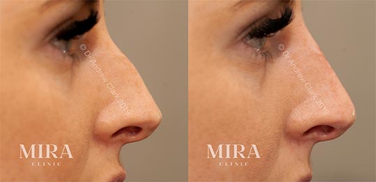 Non-Surgical Rhinoplasty/Nosejob - 4 - Mira Clinic Mira clinic liquid nose job rhinoplasty before and after1 - mira clinic - 3