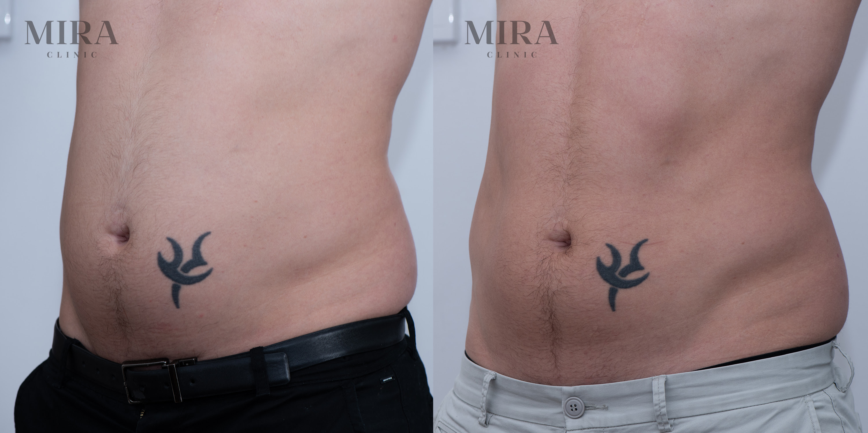 Emsculpt before and after image - blog article