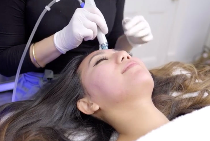 Hydrafacial treatment - during treatment - featured blog image