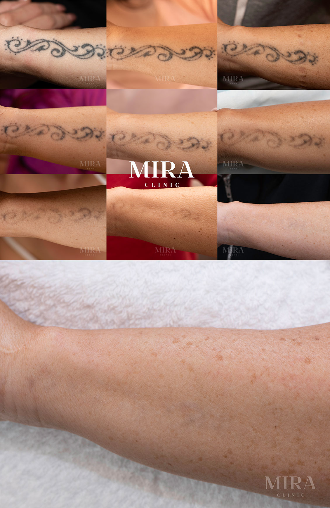 Mira clinic complete tattoo removal before and after nine separate treatments