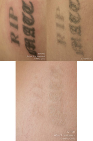 Mira clinic tattoo removal before after 3 - mira clinic - 7