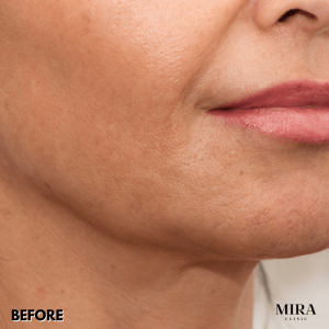 We Have A Range Of Non-Surgical Treatment Options To Lift And Tighten Your Neck Line And Profile - 4 - Mira Clinic 2 1 - mira clinic - 3