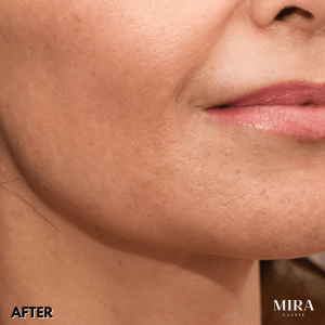 We Have A Range Of Non-Surgical Treatment Options To Lift And Tighten Your Neck Line And Profile - 6 - Mira Clinic 3 1 - mira clinic - 5