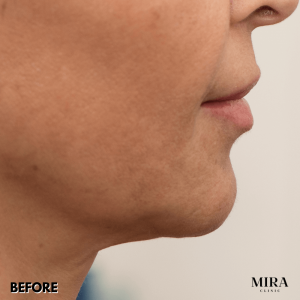 We Have A Range Of Non-Surgical Treatment Options To Lift And Tighten Your Neck Line And Profile - 8 - Mira Clinic 4 1 - mira clinic - 7