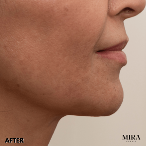 We Have A Range Of Non-Surgical Treatment Options To Lift And Tighten Your Neck Line And Profile - 10 - Mira Clinic 5 1 - mira clinic - 9