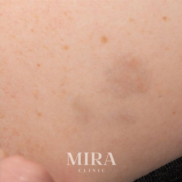Laser Tattoo Removal At Mira Clinic West Perth. - 6 - Mira Clinic Ltr after img7 - mira clinic - 5
