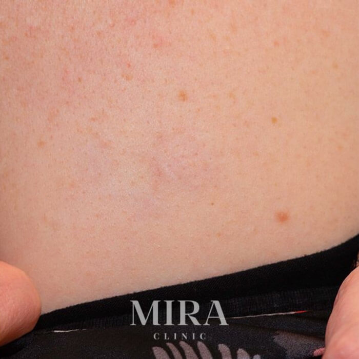 Laser Tattoo Removal At Mira Clinic West Perth. - 8 - Mira Clinic Ltr after img9 - mira clinic - 7
