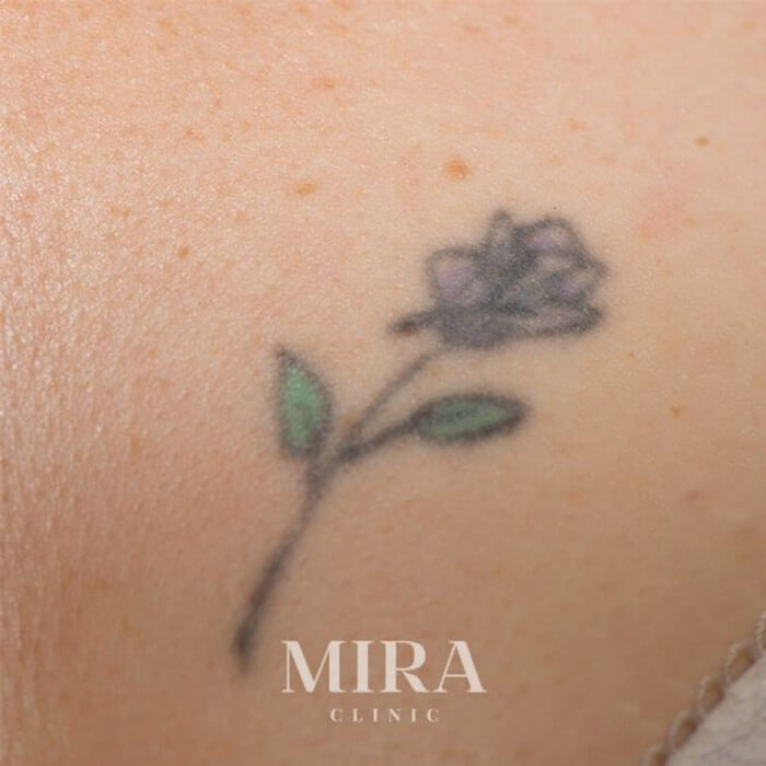Laser Tattoo Removal At Mira Clinic West Perth. - 4 - Mira Clinic Ltr before img - mira clinic - 3