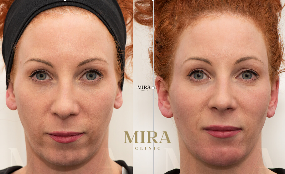 Mira clinic patient after undergoing a series of tailered treatments to subtly help her face shape more closely resemble an ideal shape as defined by peer reviewed scientific journal articles 1 - mira clinic - 5