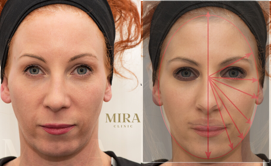 Mira clinic patient with professor goodmans oval ideal female face shape overlaid - mira clinic - 1